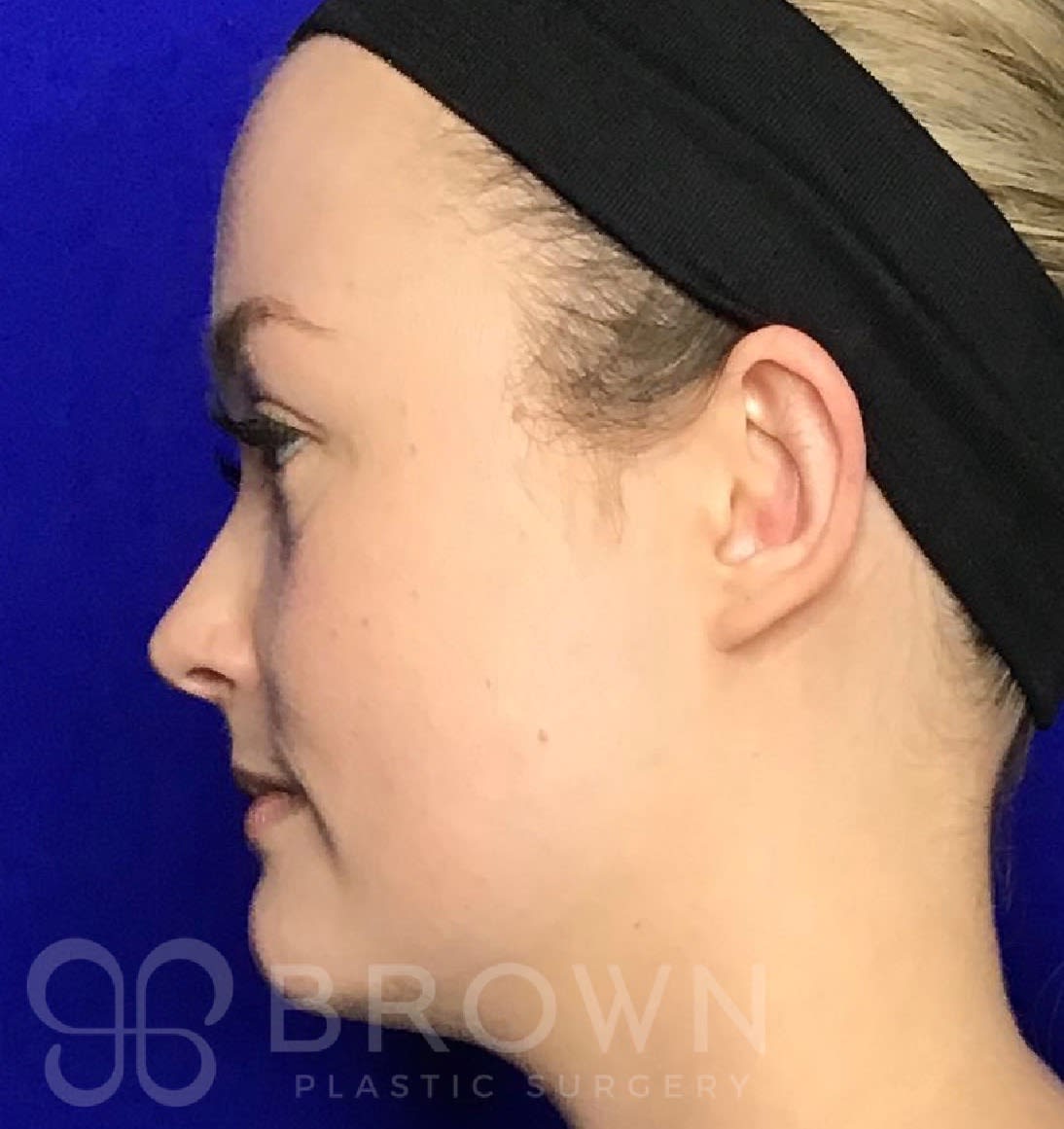 Ear Surgery (Otoplasty) After, undefined undefined - 3153