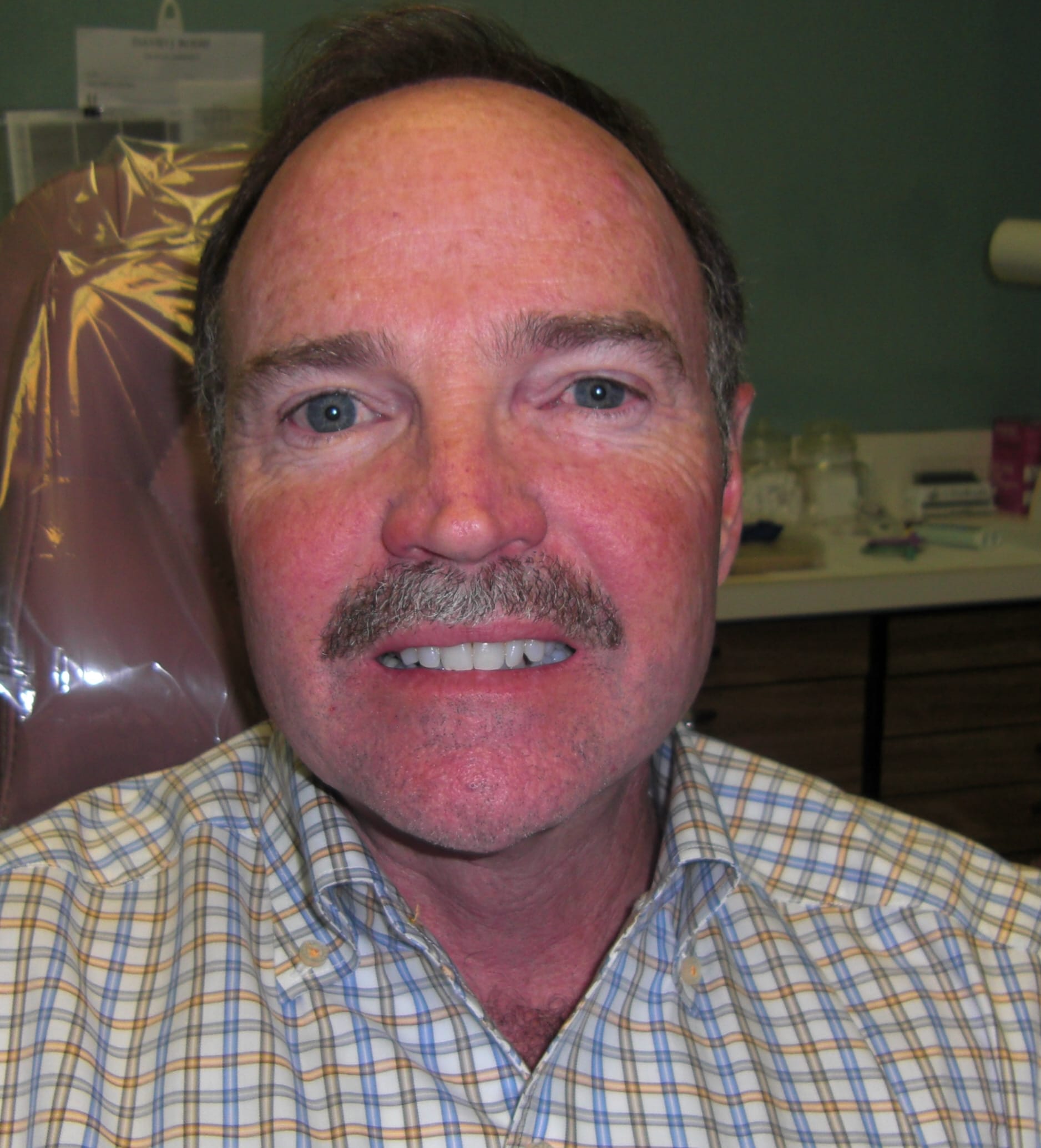 Dental Veneers Before, undefined undefined - 1134
