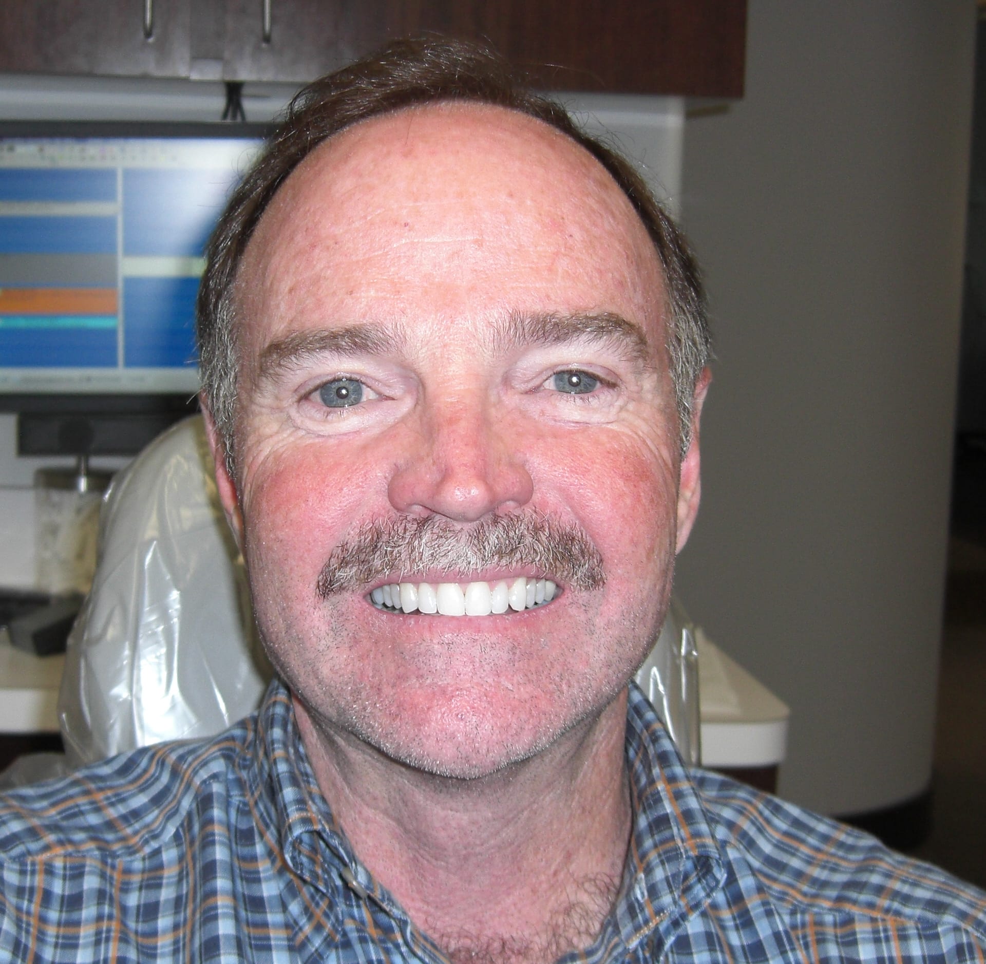 Dental Veneers After, undefined undefined - 1134