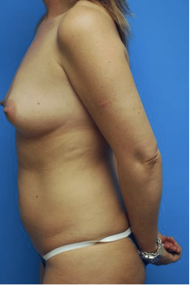 Breast Augmentation with Implants Before, undefined undefined - 120