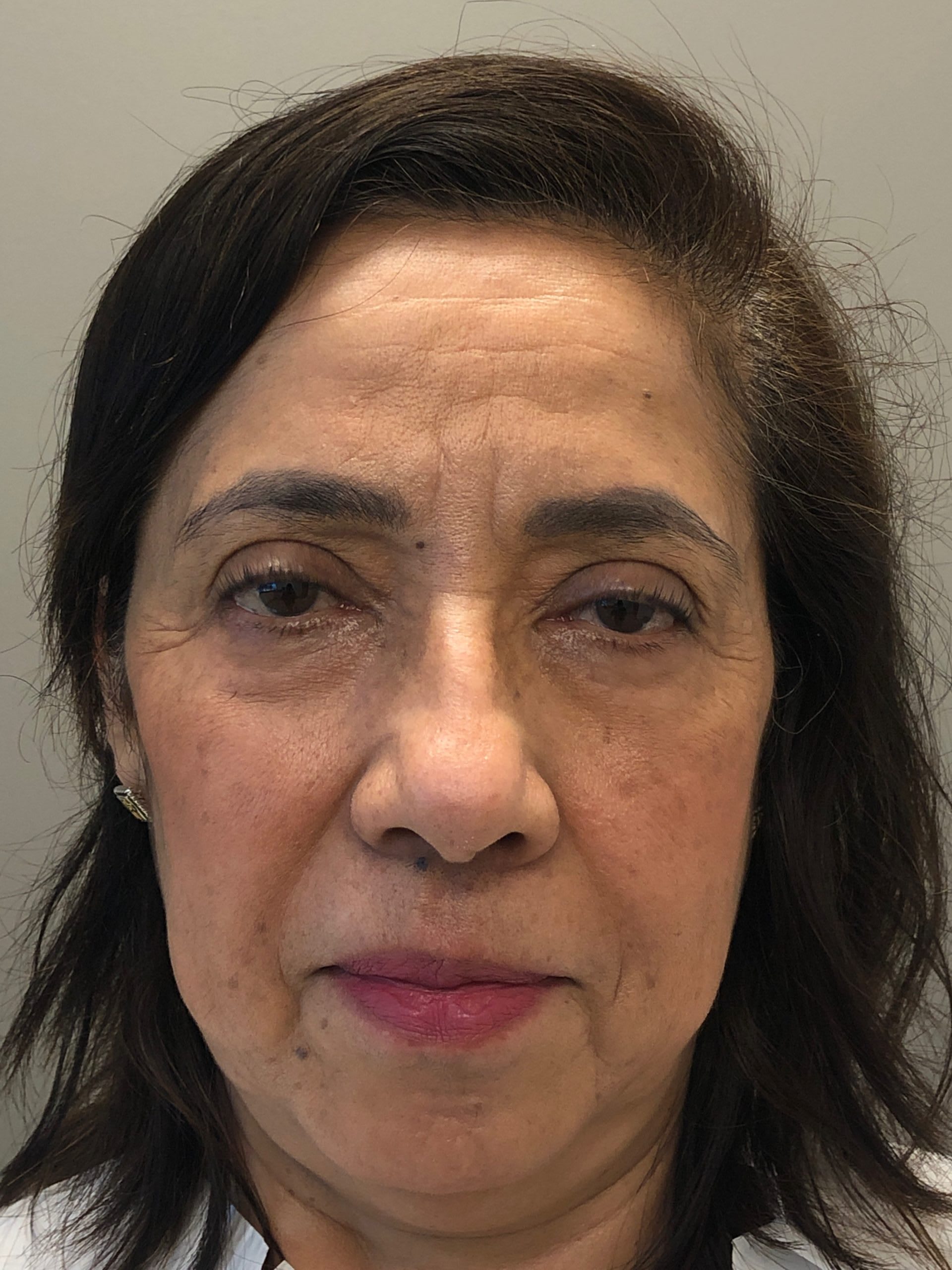 Blepharoplasty After, undefined undefined - 2685