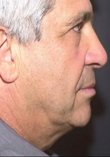 Facelift Before, undefined undefined - 2021