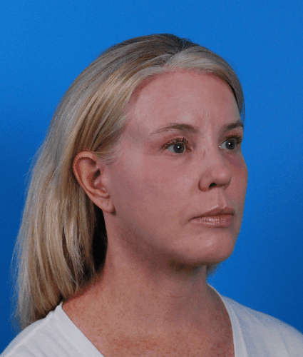 Facelift After, undefined undefined - 2353