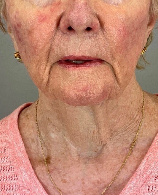 Facelift Before, undefined undefined - 2663