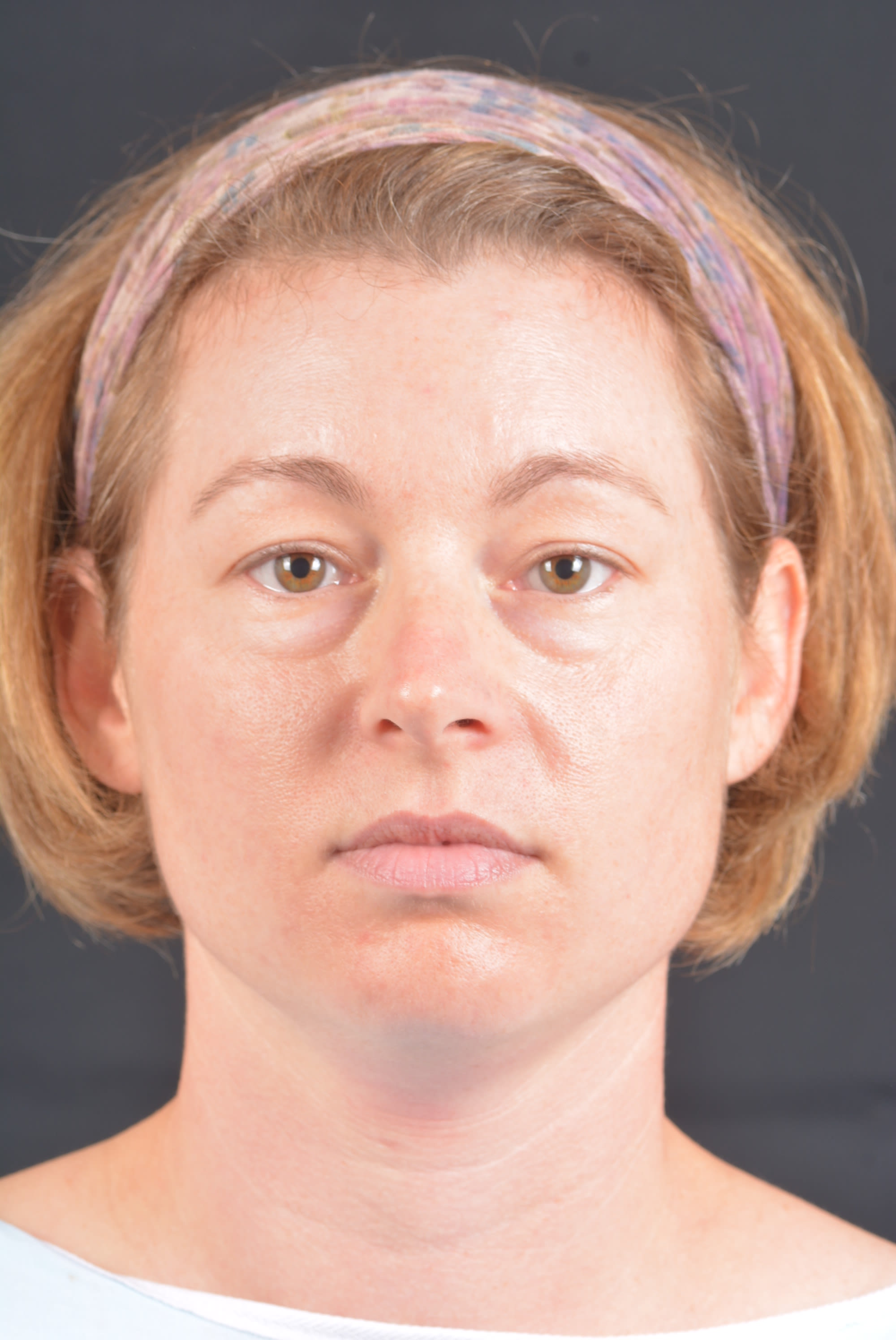 Blepharoplasty Before, undefined undefined - 81