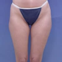 Body Contouring Solutions Before, undefined undefined - 4314