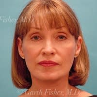 Facelift After, undefined undefined - 4308