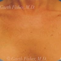 Laser Skin Resurfacing After, undefined undefined - 4319
