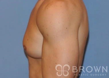 Male Breast Reduction Before, undefined undefined - 3191