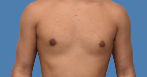 Male Breast Reduction After, undefined undefined - 2067