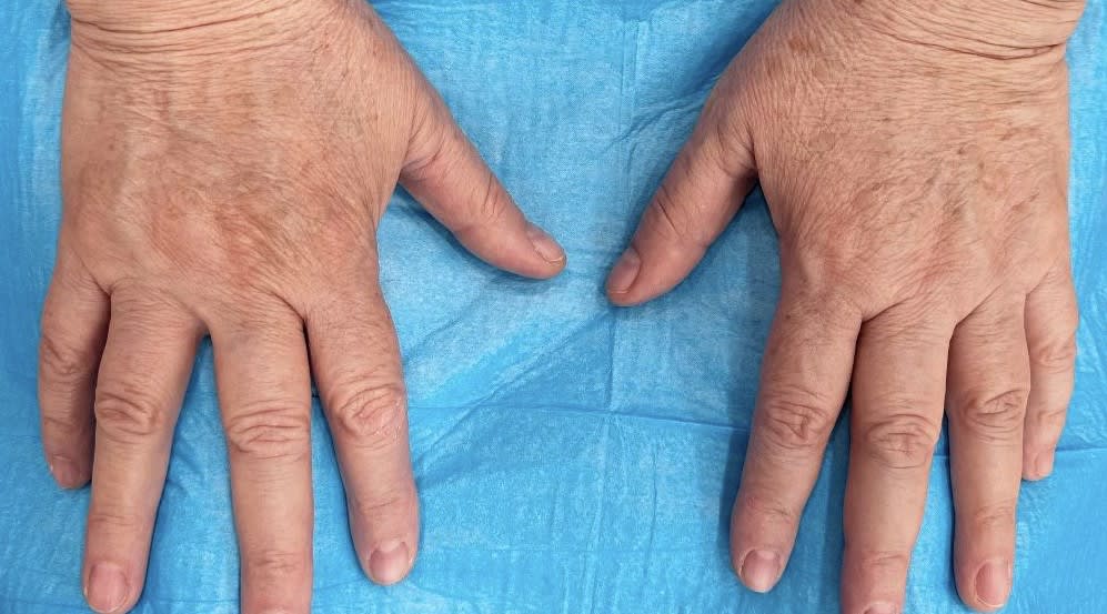 Laser Hand Rejuvenation After, undefined undefined - 4157