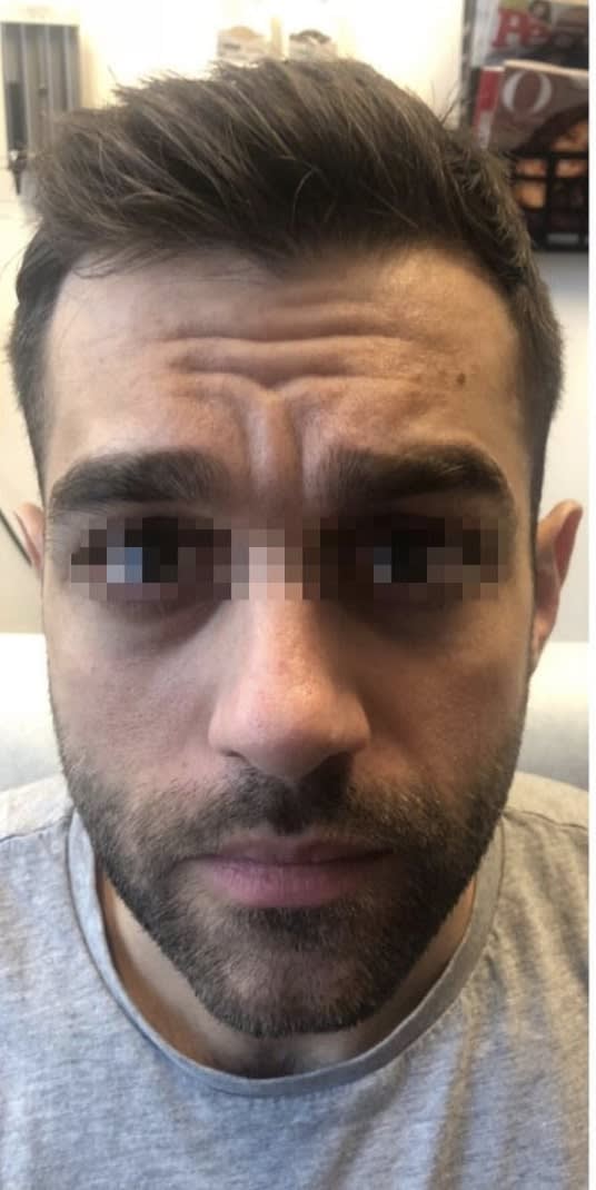 Under Eye Filler Before, undefined undefined - 1168