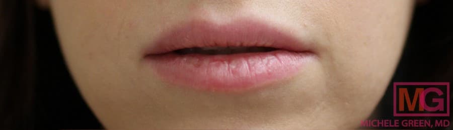 Temporary Lip Fillers Before, undefined undefined - 1109