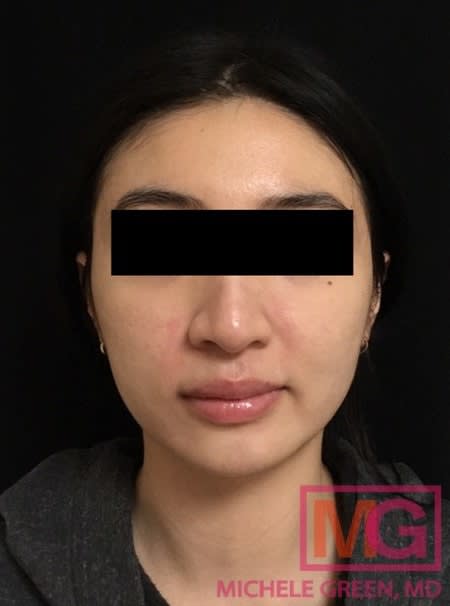 Acne Scar Treatment After, undefined undefined - 1098