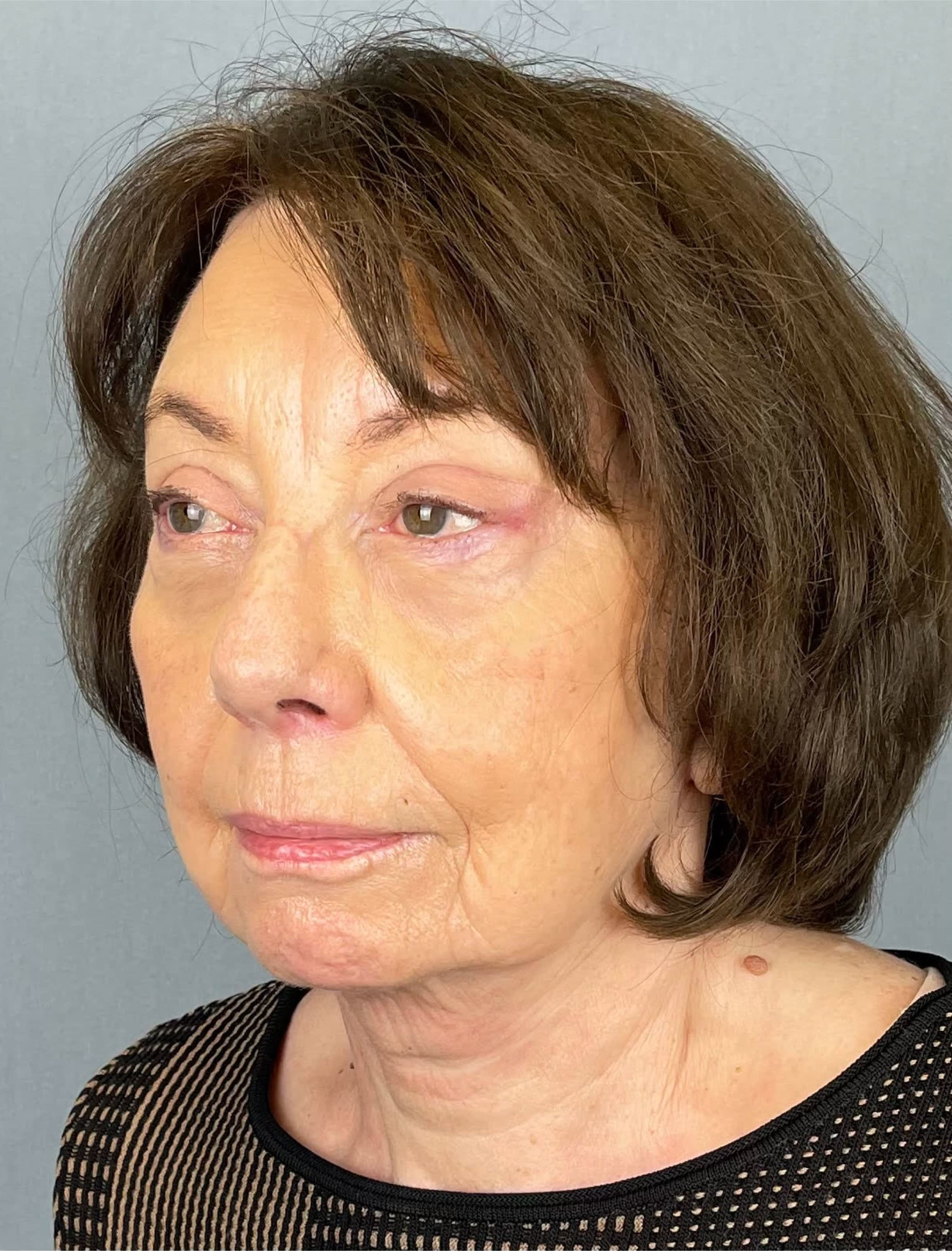 Facelift After, undefined undefined - 1309