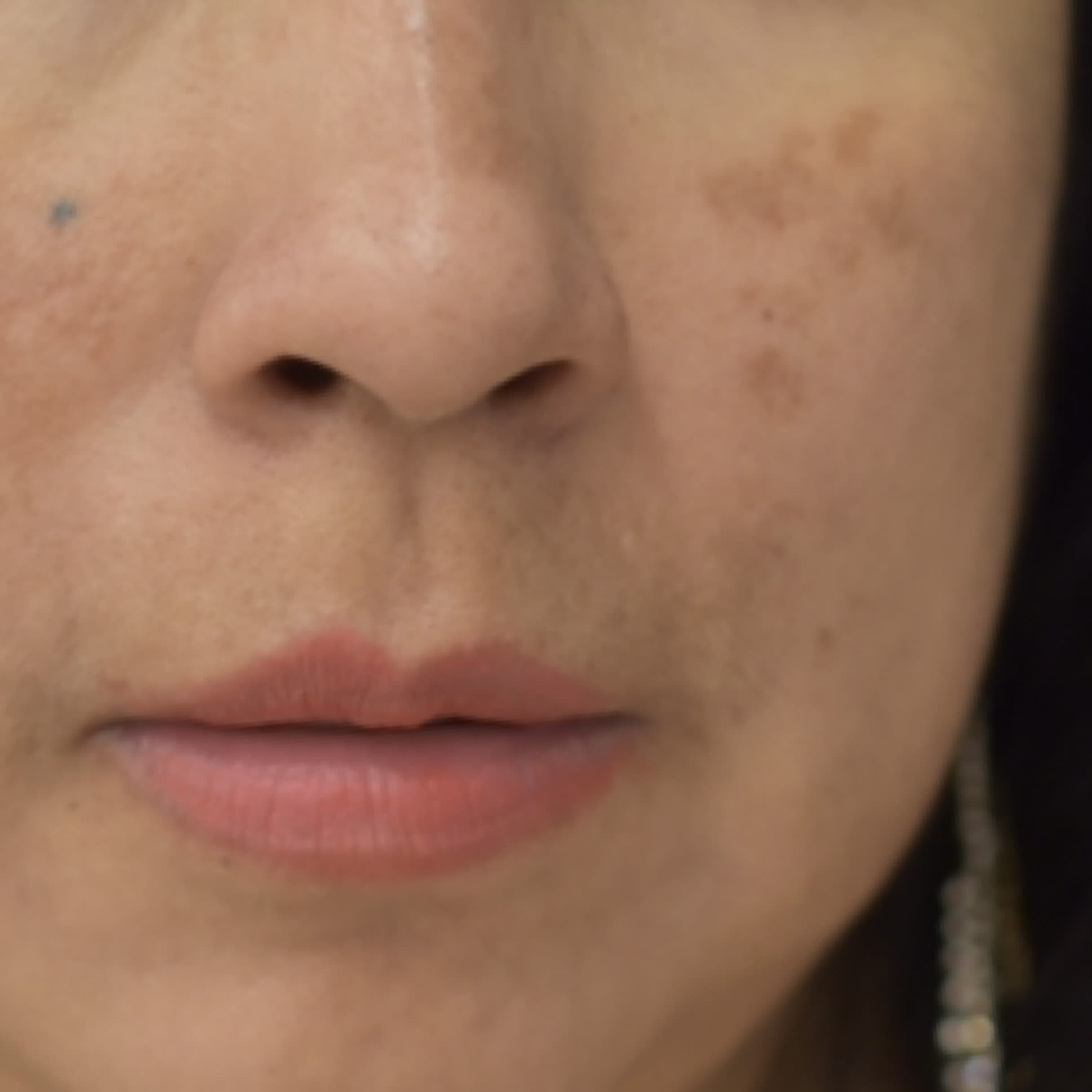 Chemical Peels Before, undefined undefined - 630