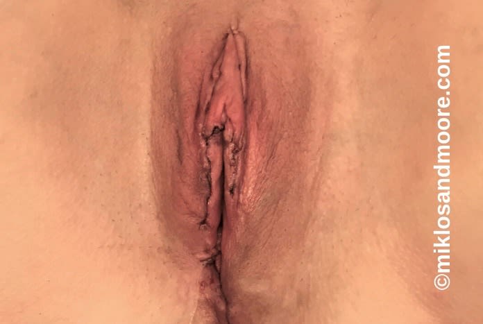 Vaginal Rejuvenation Solutions After, undefined undefined - 2003