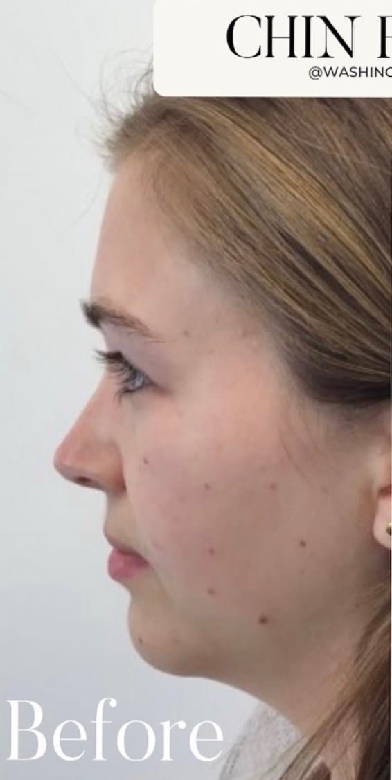 Chin Augmentation with Soft Tissue Fillers Before, undefined undefined - 3125