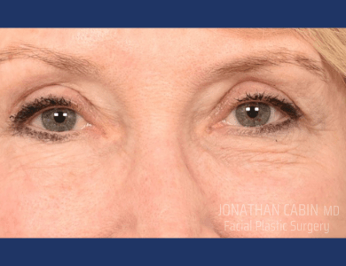 Blepharoplasty After, undefined undefined - 1931
