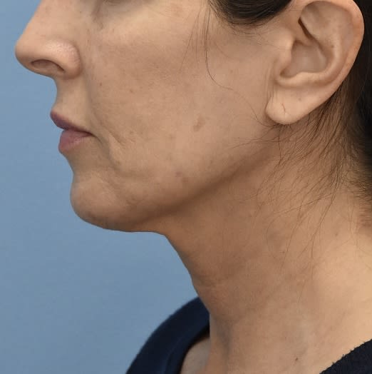 Dermal Fillers & Injectables After, undefined undefined - 1206