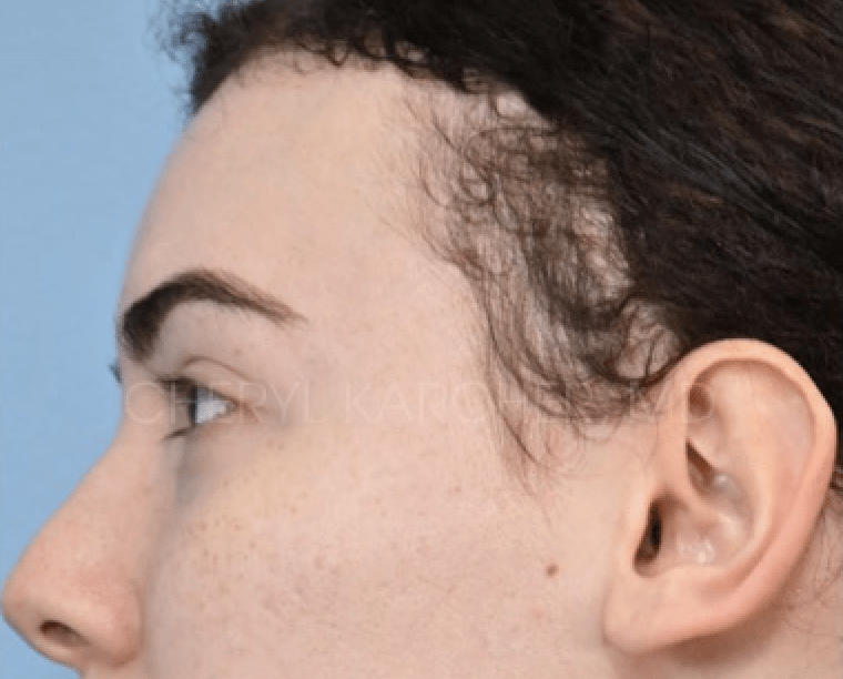 Nanofat & PRP Injections for Hair Loss Before, undefined undefined - 230