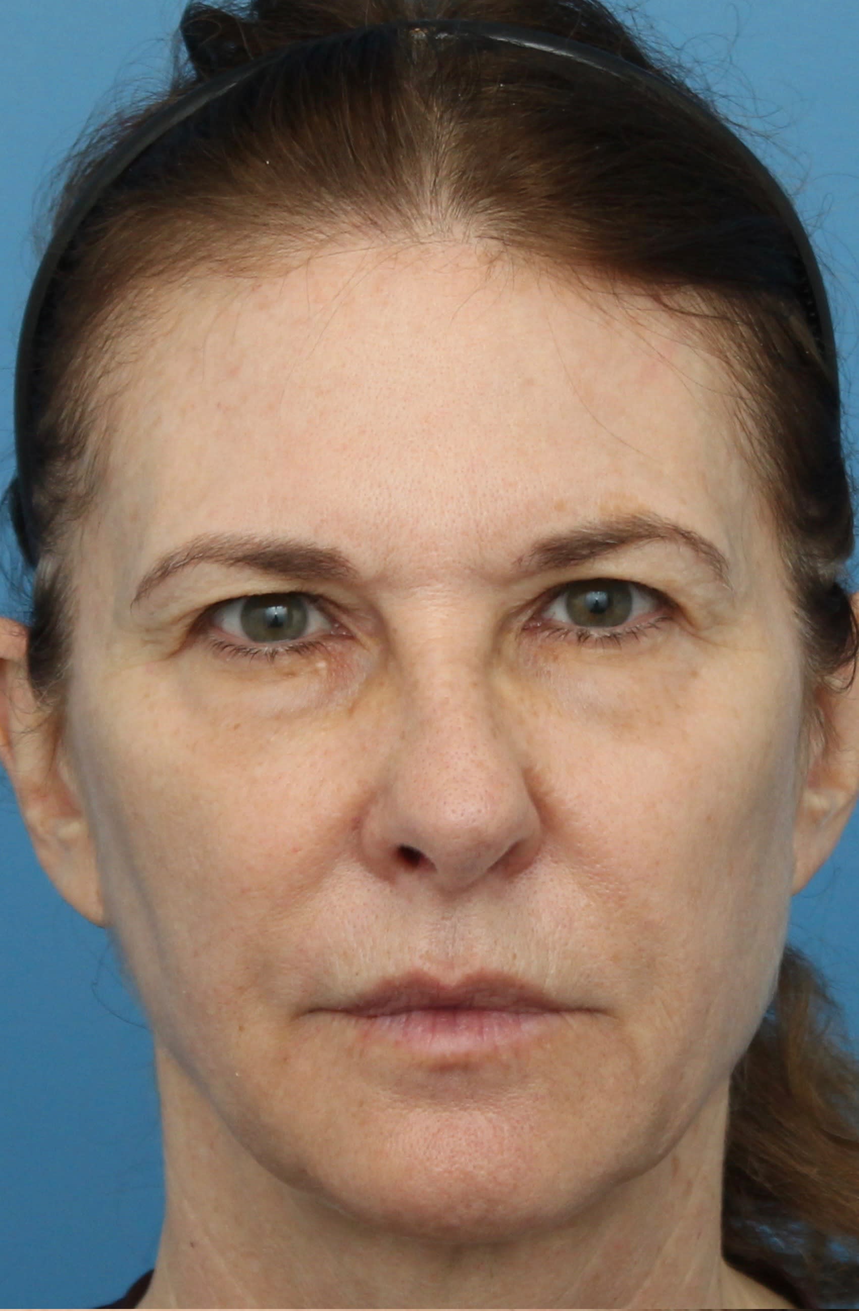 Brow Lift Before, undefined undefined - 1394