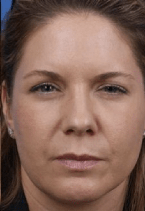 Botox After, undefined undefined - 124