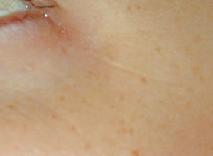 Skin Resurfacing Solutions After, undefined undefined - 2089
