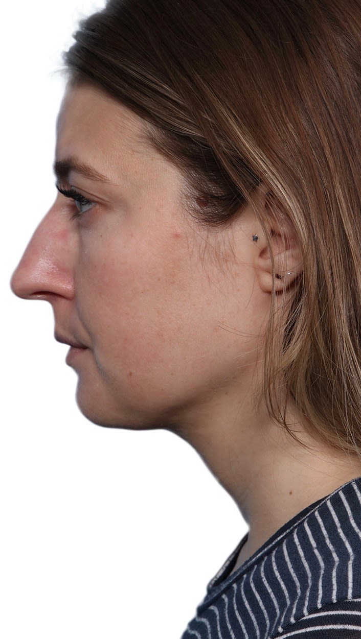 Buccal Fat Removal After, undefined undefined - 2314