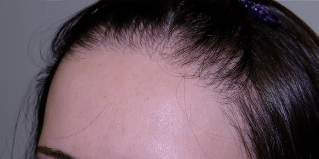Follicular Unit Extraction After, undefined undefined - 2739