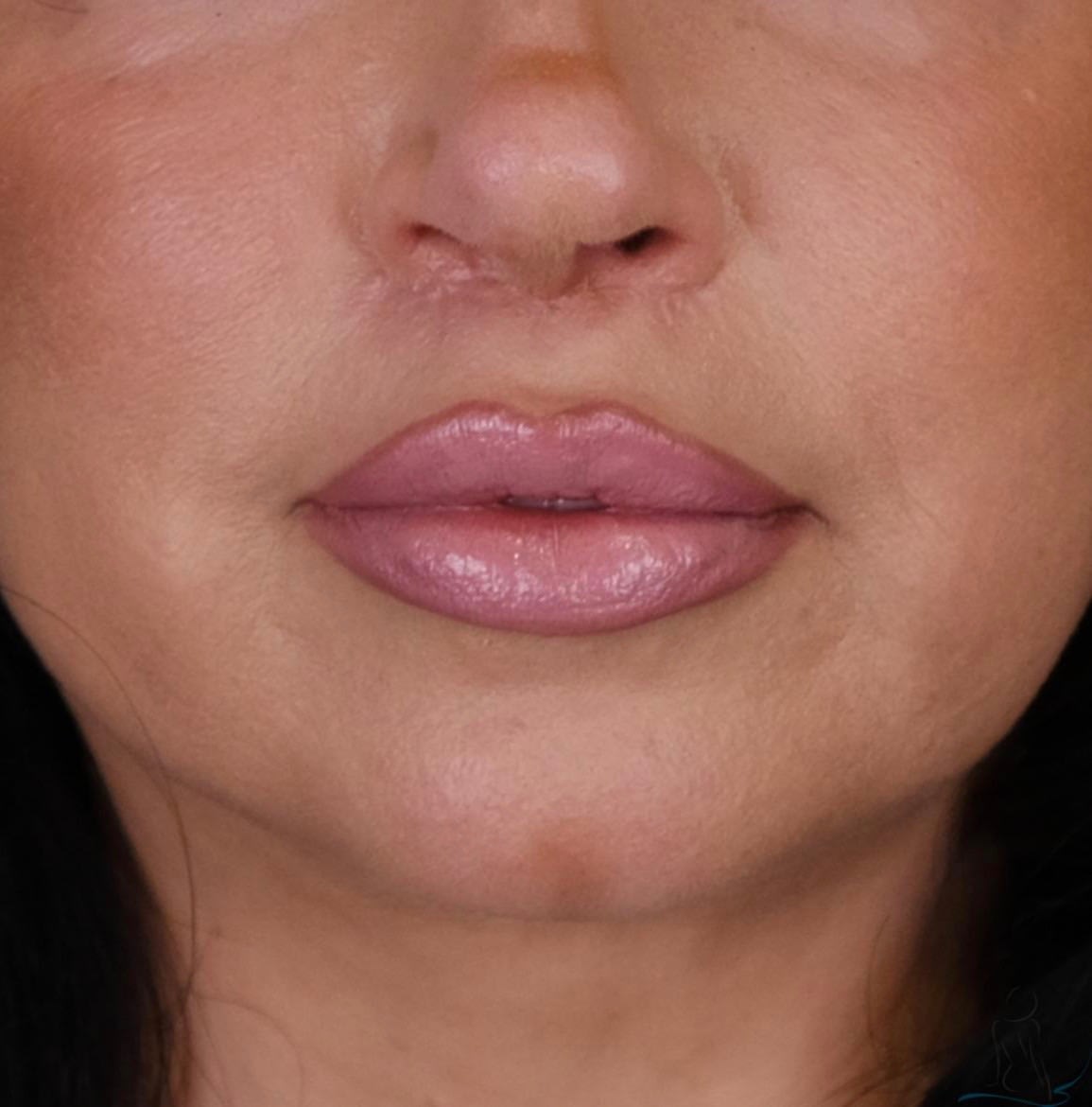Subnasal 'Bullhorn' Lip Lift After, undefined undefined - 2369