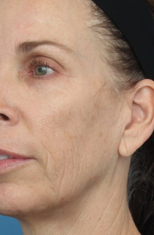 Neck Lift Before, undefined undefined - 1405