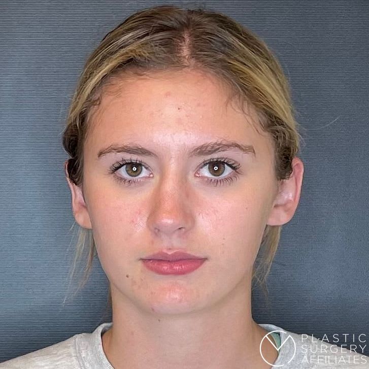 Otoplasty After, undefined undefined - 2284