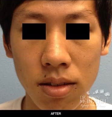 Nose Augmentation & Nose Reduction Solutions After, undefined undefined - 2458