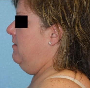 Neck Lift Before, undefined undefined - 3410