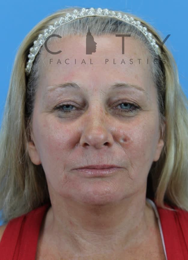 Facelift After, undefined undefined - 365