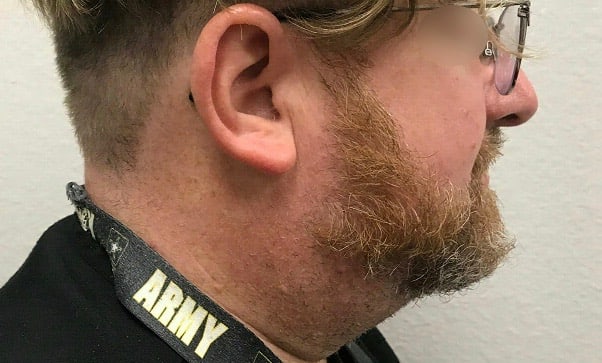Neck Lift Before, undefined undefined - 2680