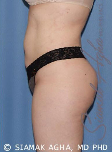 Brazilian Butt Lift After, undefined undefined - 2537