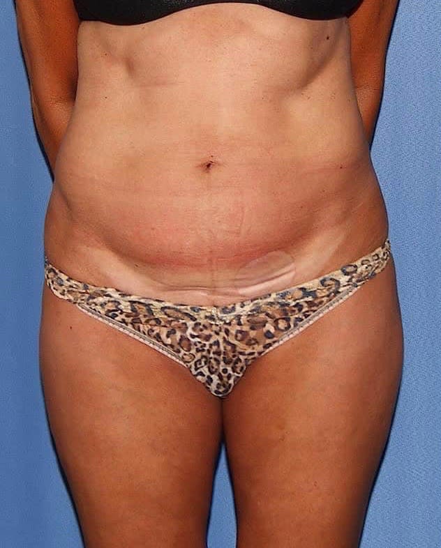 Mini Tummy Tuck Before, undefined undefined - 2577