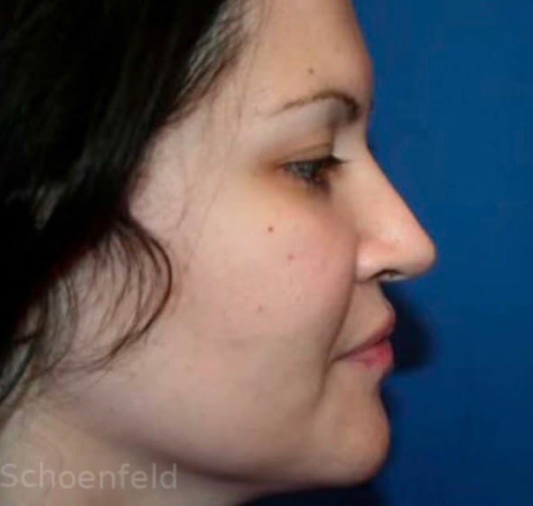 Rhinoplasty After, undefined undefined - 2703