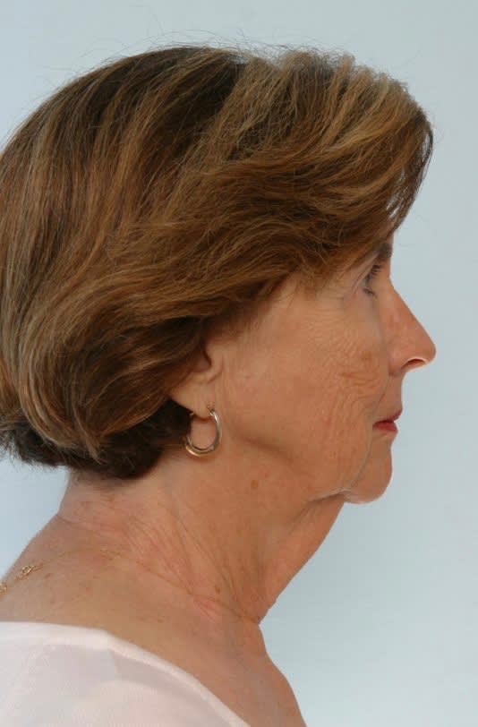 Chin Augmentation Before, undefined undefined - 1877