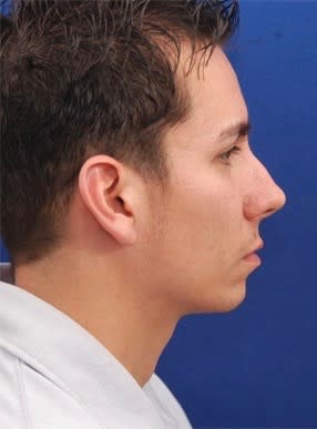 Chin Augmentation Before, undefined undefined - 1910