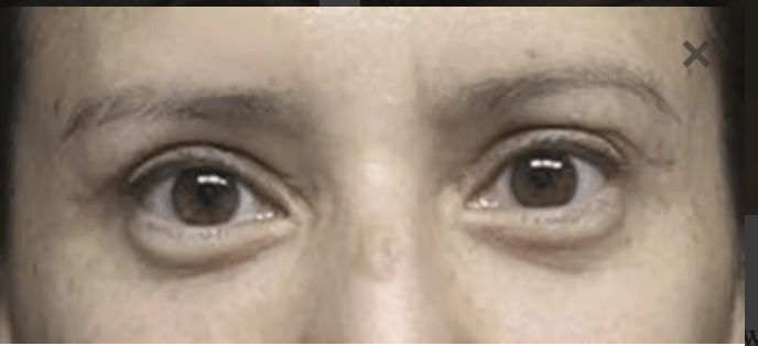 Blepharoplasty After, undefined undefined - 3030