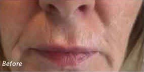Plasma Skin Resurfacing Before, undefined undefined - 2210