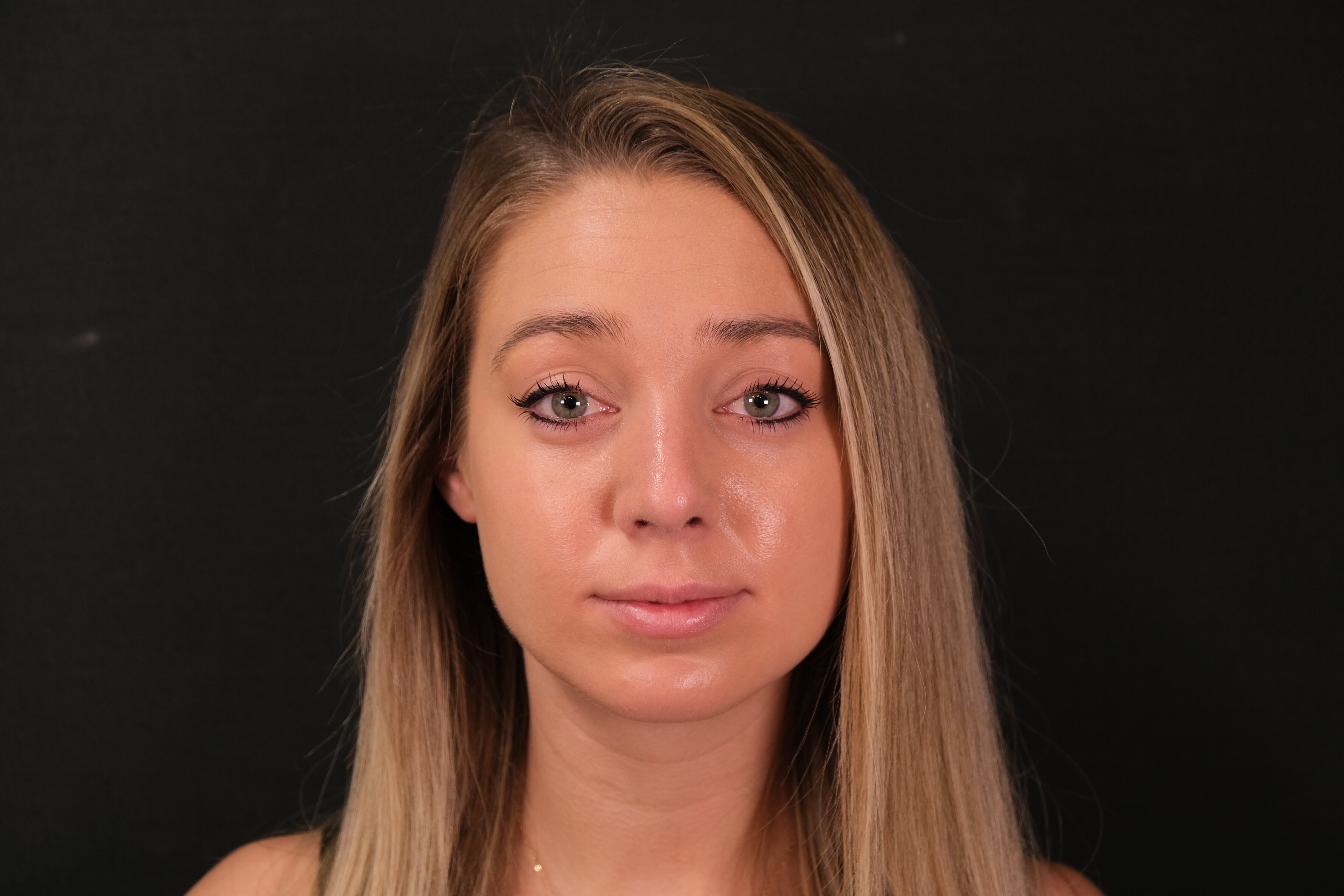 Rhinoplasty After, undefined undefined - 1532