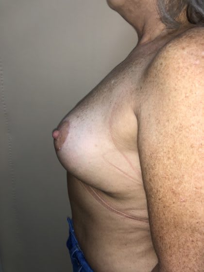 Breast Lift After, undefined undefined - 4186