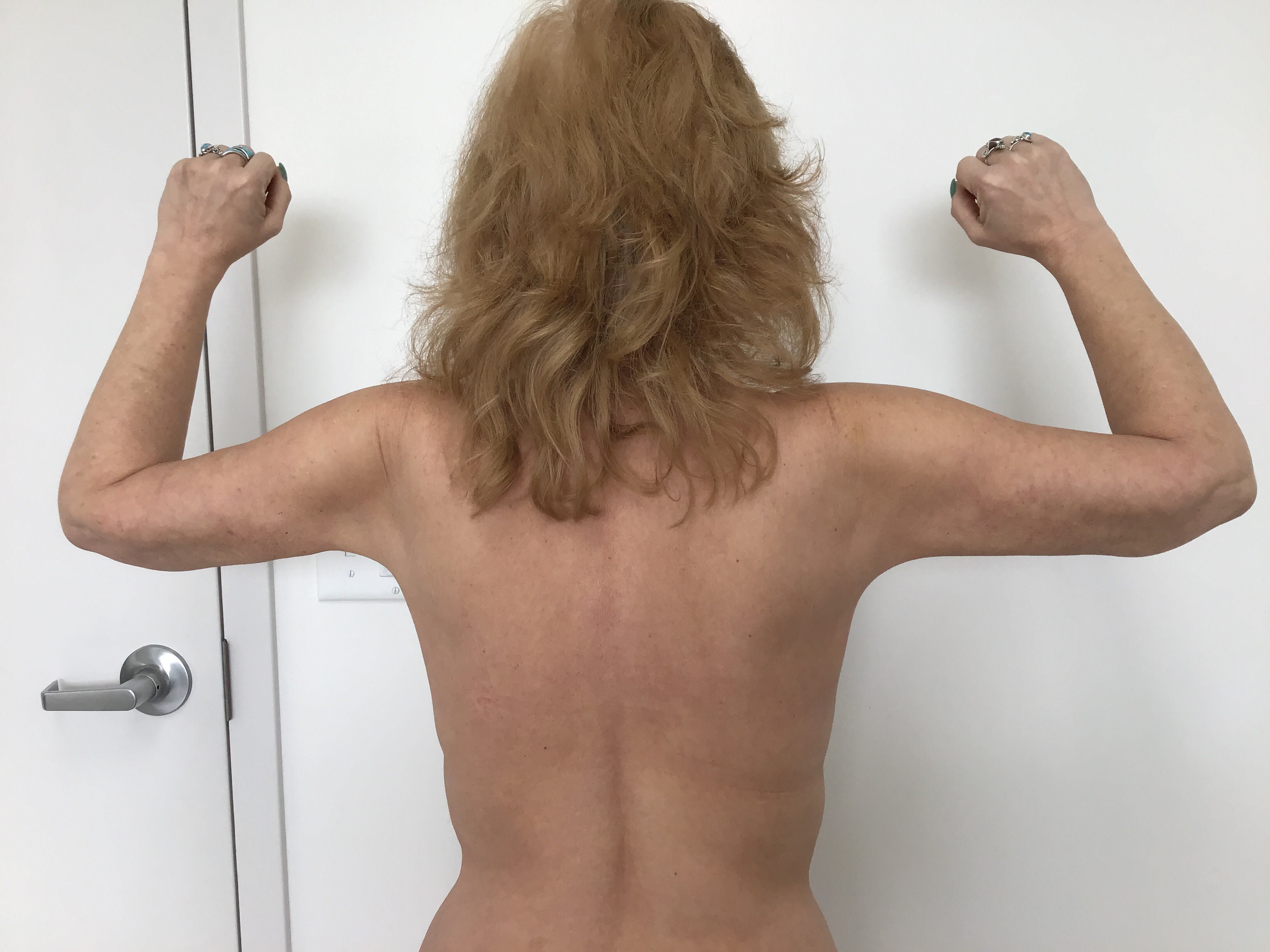 Arm Lift (Brachioplasty) After, undefined undefined - 2043