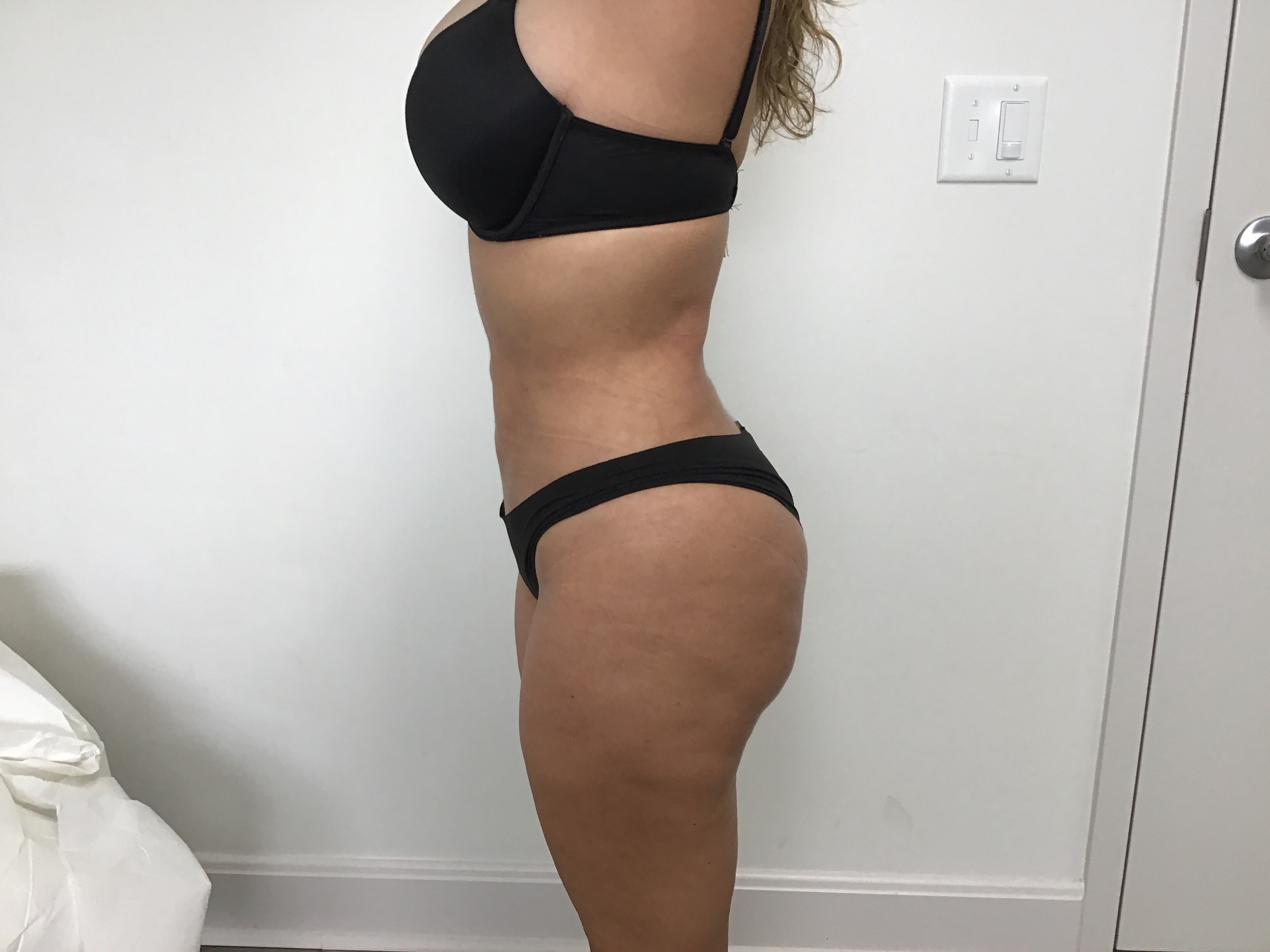 Brazilian Butt Lift After, undefined undefined - 2054
