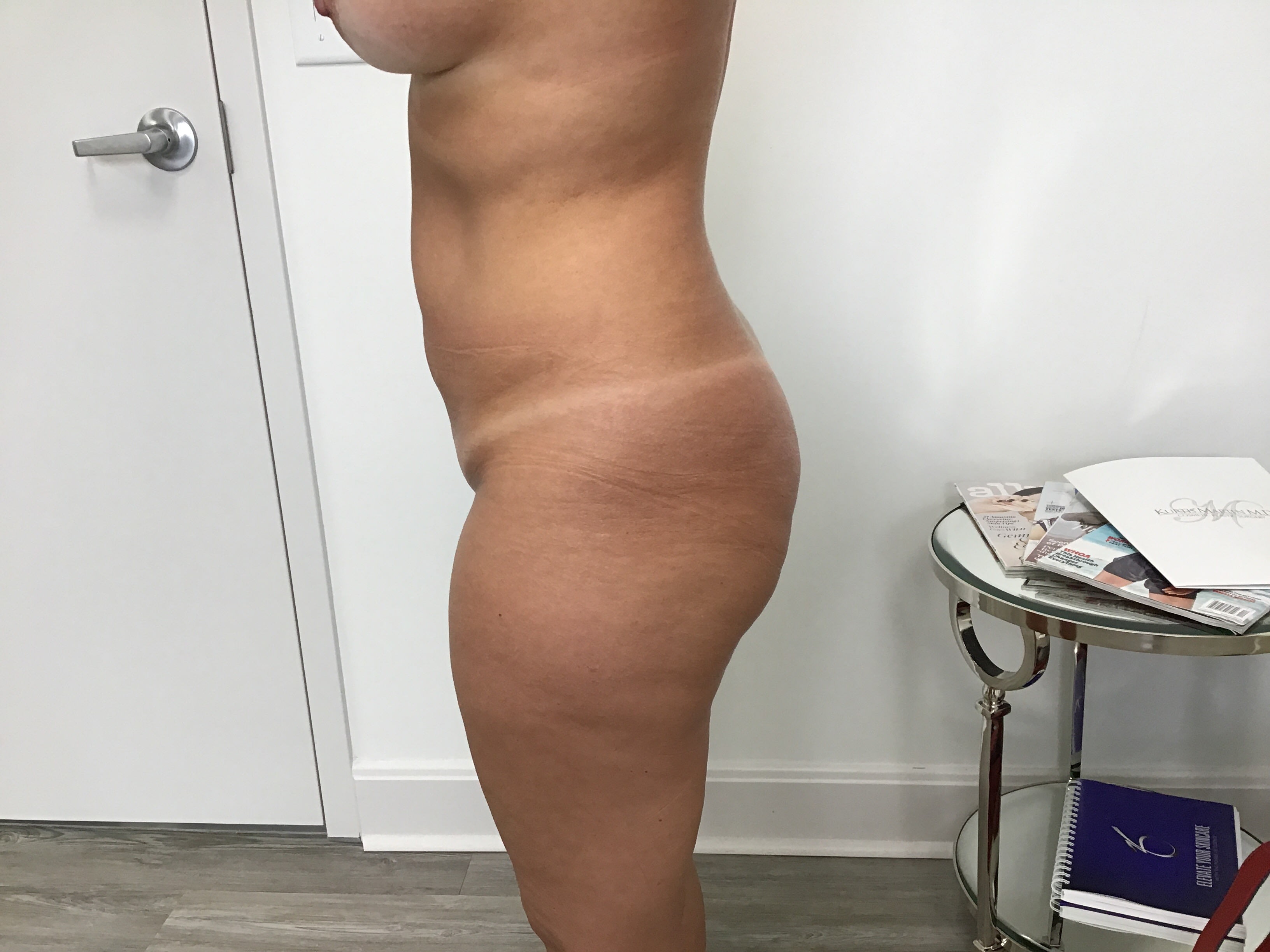 Brazilian Butt Lift Before, undefined undefined - 2054