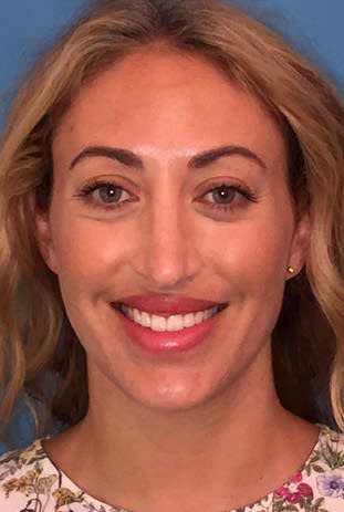 Revision Rhinoplasty Before, undefined undefined - 2149